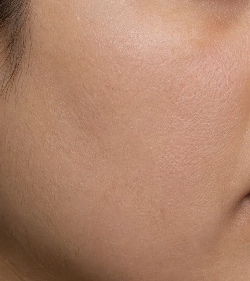 Redness and dehydration — Week 12