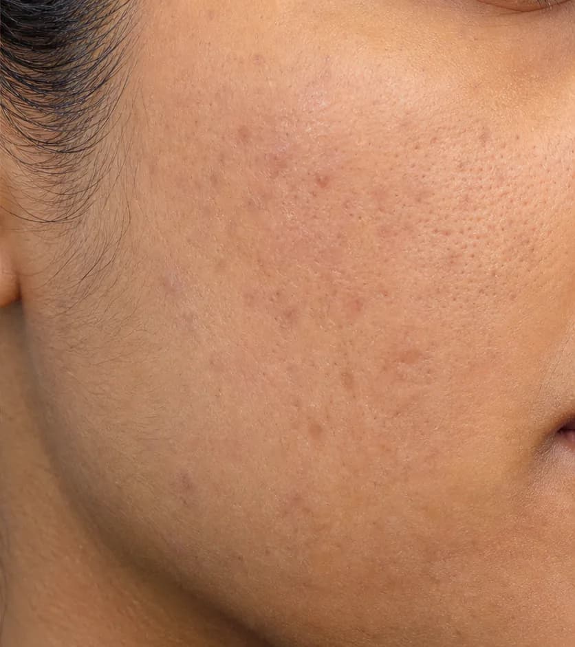 Aisha — skin after 12 weeks on the Clear Skin Protocol