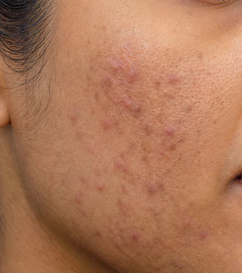 Aisha — skin before starting the Clear Skin Protocol