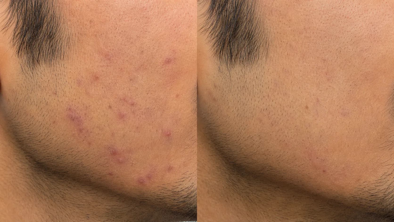Jawline breakouts before-and-after pair