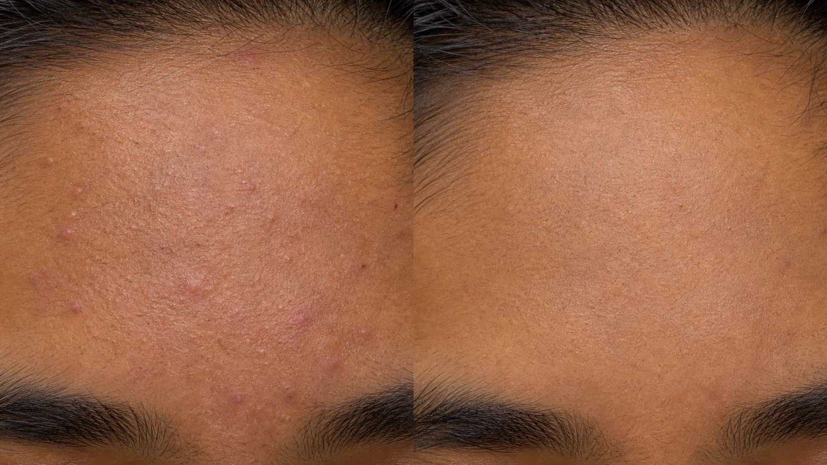 Forehead congestion before-and-after pair