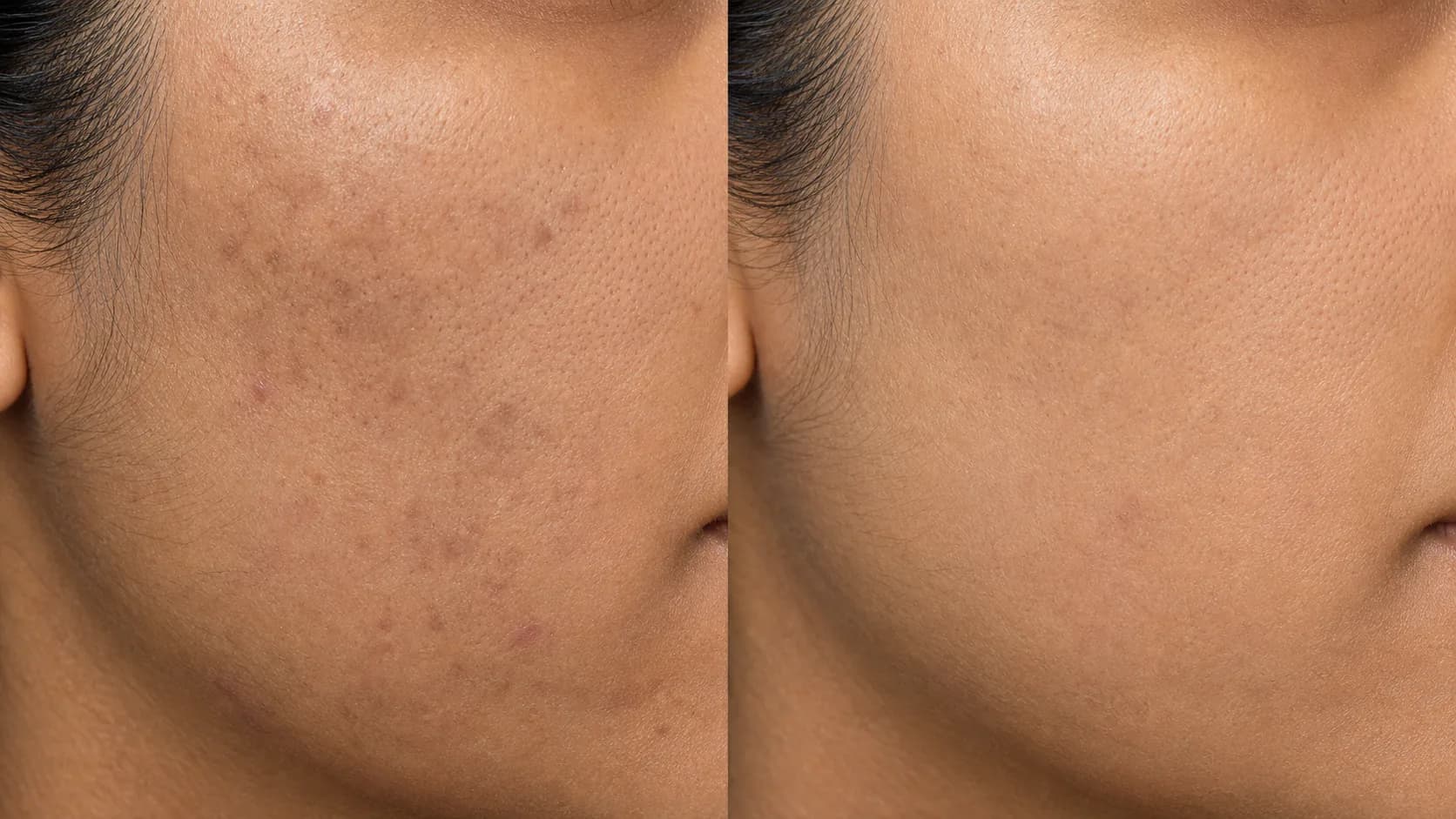 Hamza — before and after the Clear Skin Protocol