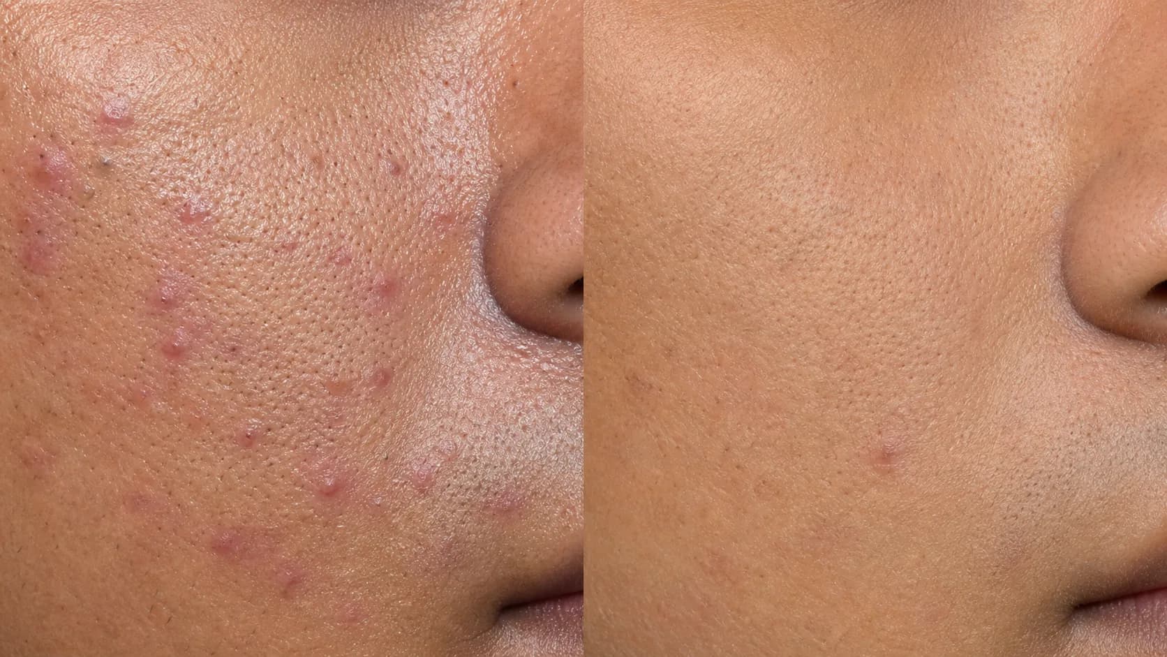 Oily pores before-and-after pair