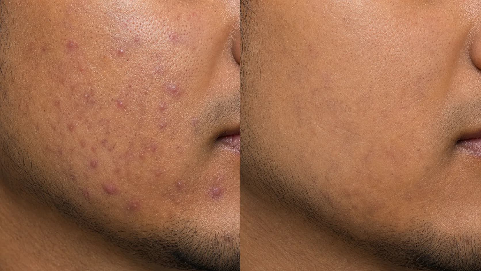 Mixed lower-face acne before-and-after pair