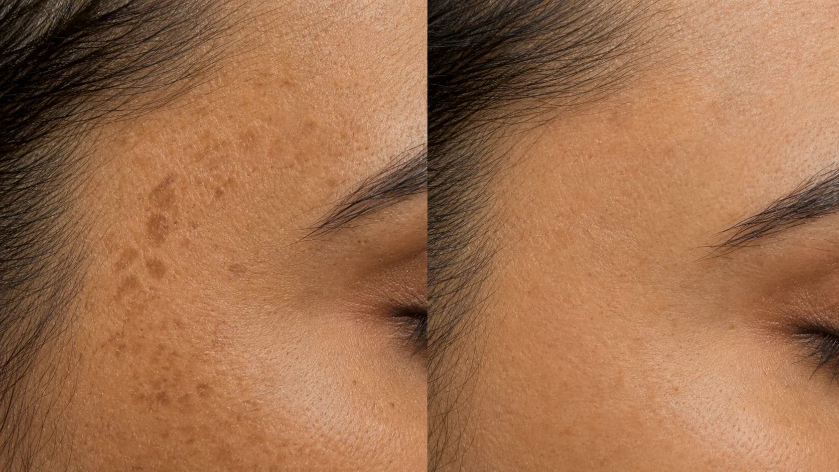 Fatima — before and after the Even Tone Protocol
