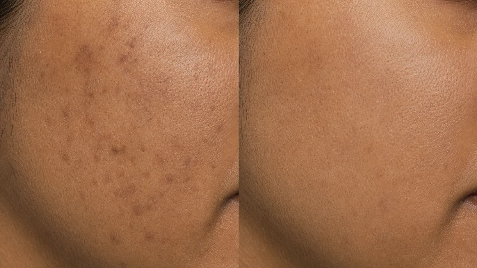 Post-inflammatory pigment before-and-after pair