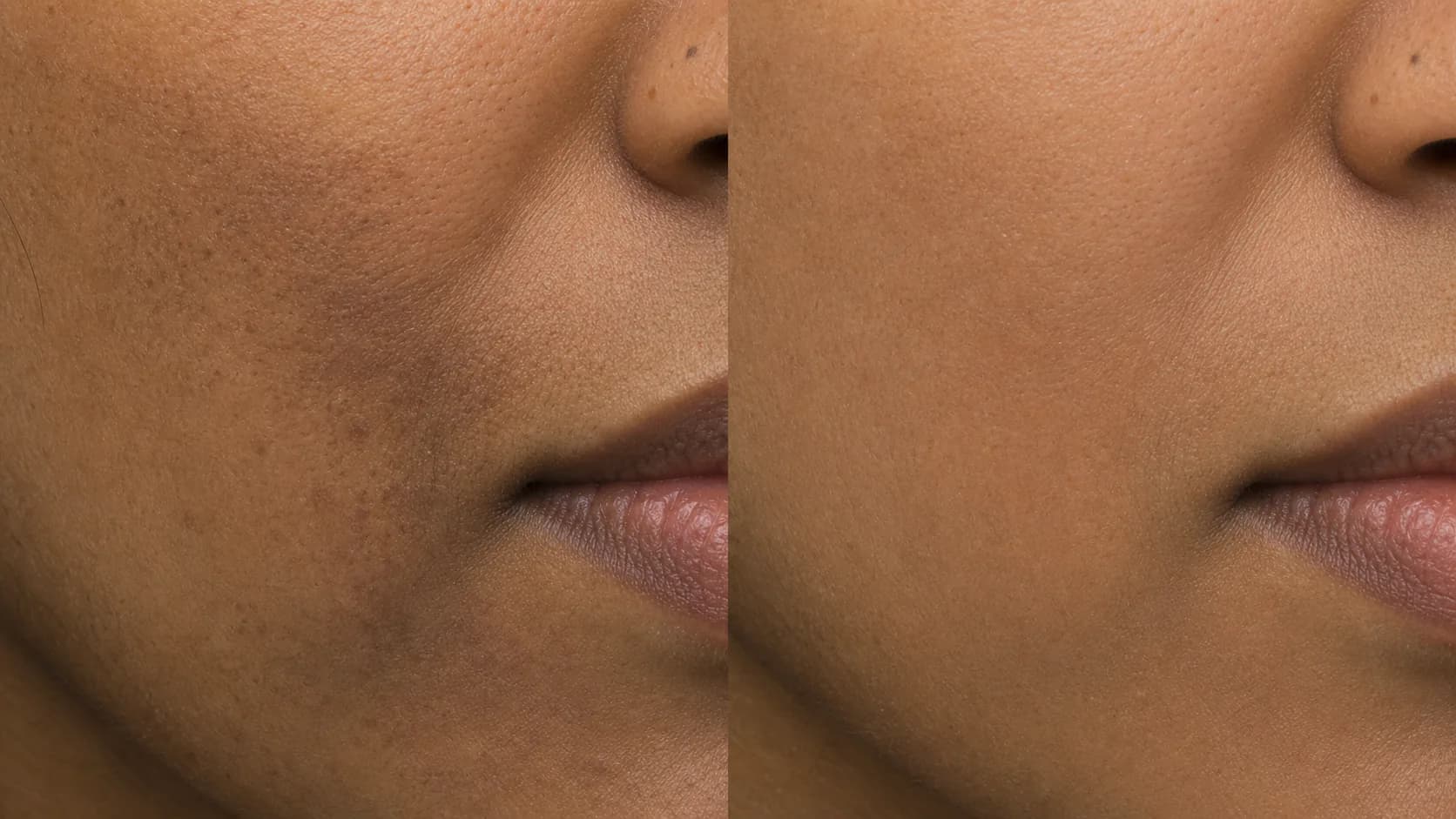 Perioral pigmentation before-and-after pair