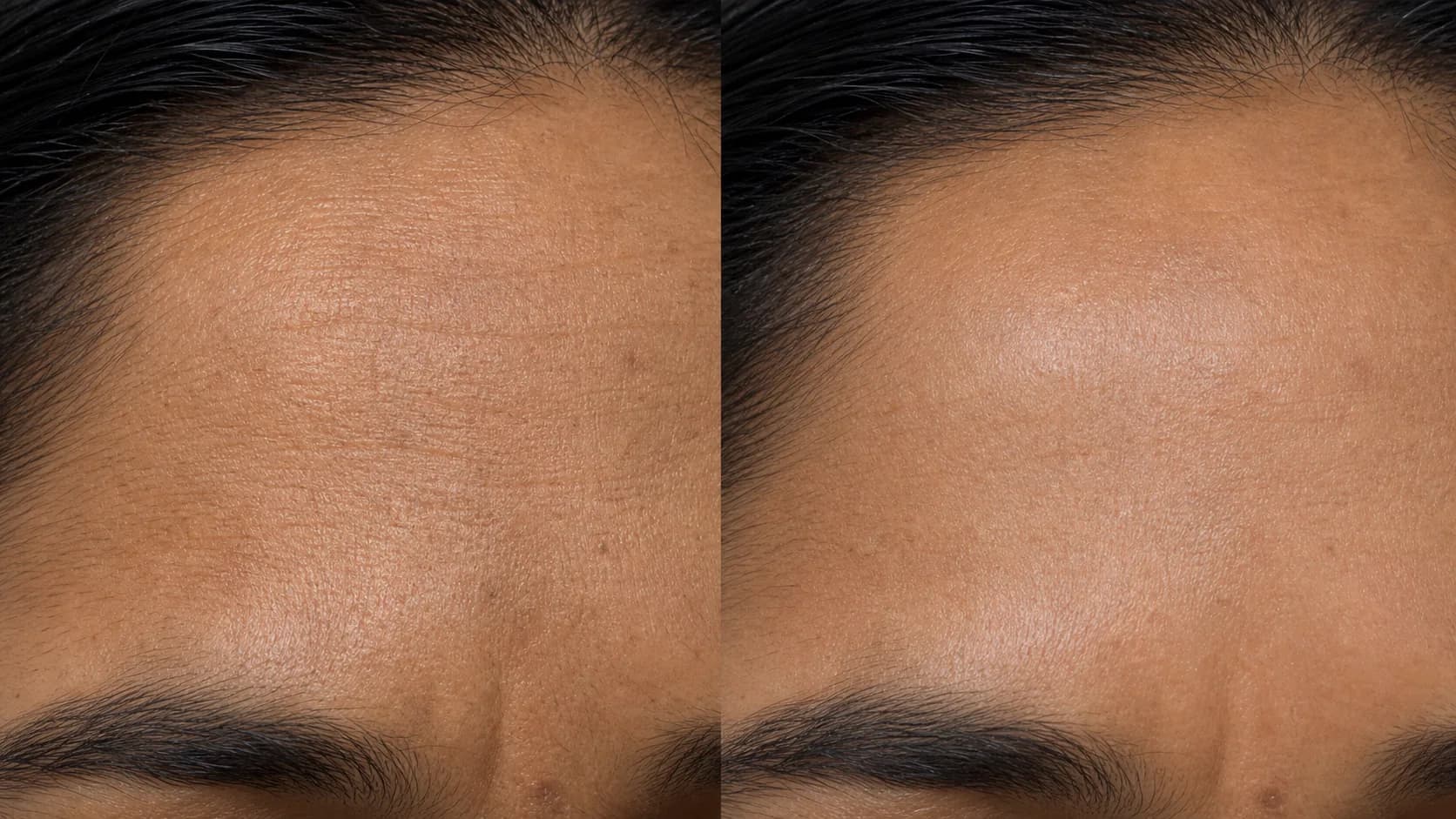 Forehead lines before-and-after pair