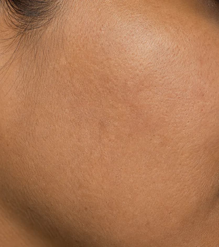 Cheek melasma — Week 12