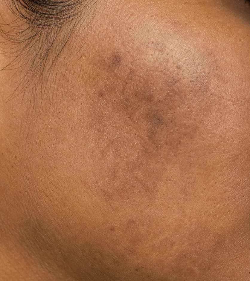 Cheek melasma — before