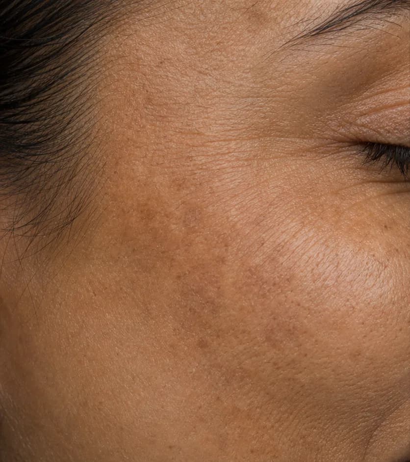 Fine lines and texture — before